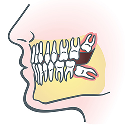 wisdom teeth